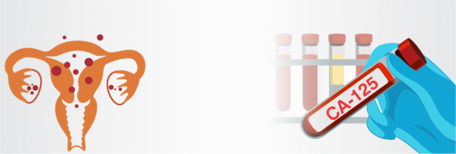 Blog Images CA 125 The blood test that helps you stays one step ahead of ovarian cancer